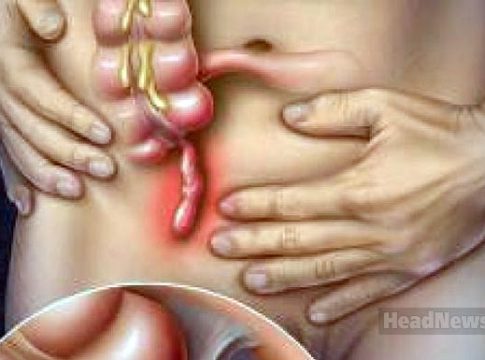 При аппендиците операция необязательна Аппендицит, Appendicitis. Медицинские новости, здоровье. МедЭксперт